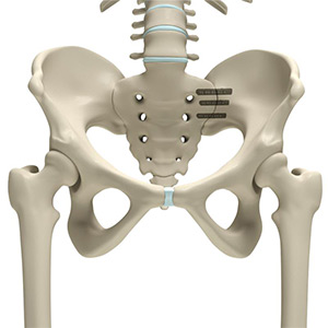 iFuse Implant System