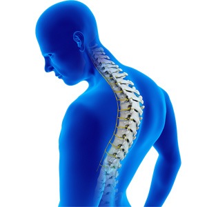 Kyphosis