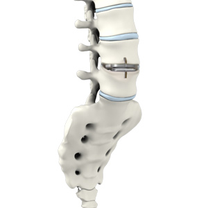 Lumbar Artificial Disc Replacement