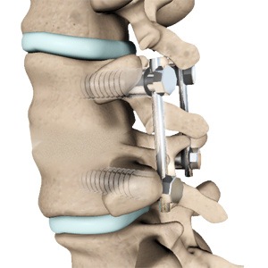 Lumbar Fusion