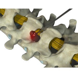 Microdiscectomy