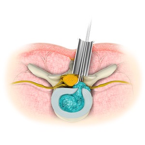 Minimally Invasive Spine Surgery