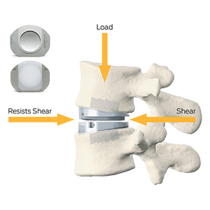 Prodisc L Disc Replacement
