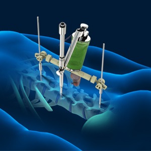 Robotic Spine Surgery