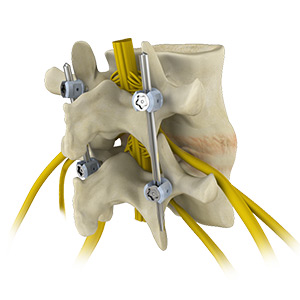 Spinal Fusion Surgery