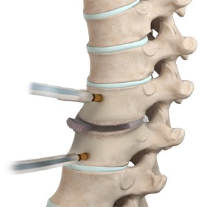 Thoracic Discectomy