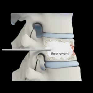 Thoracic Kyphoplasty
