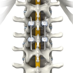 Thoracic Spine Fusion