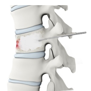 Thoracic Vertebroplasty
