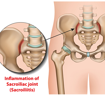Understanding Sacroiliac (SI) Joint Dysfunction: The Overlooked Cause of Low Back Pain