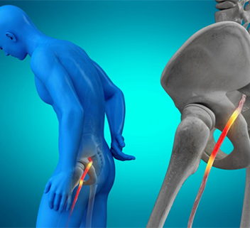 When Leg Pain Isn't a Leg Problem: How Spine Conditions Cause Sciatica and Nerve Pain