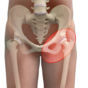 Hip Pain - 2 - Educational Photo
