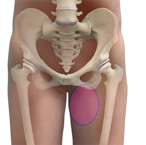 Hip Pain - 7 - Educational Photo