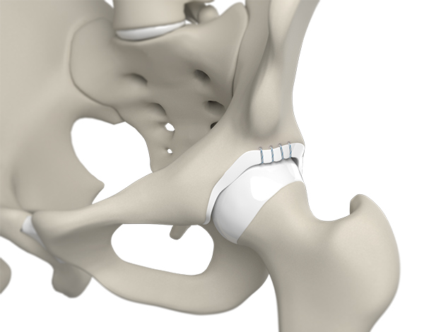 Arthroscopic Labral Repair & Reconstruction - 3 - Educational Photo