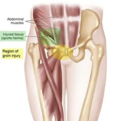 Athletic Pubalgia