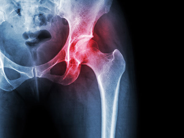 Ehlers Danlos Syndrome