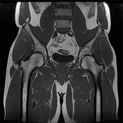 Proximal Hamstring Tear