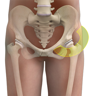 Hip Pain - 4 - Educational Photo