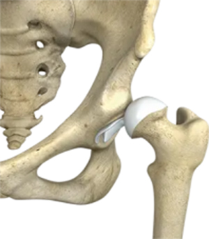 Hip Alignment Abnormalities - 4 - Educational Photo