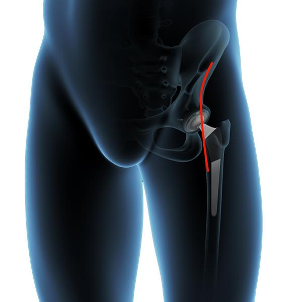 Direct Anterior Approach Hip Replacement