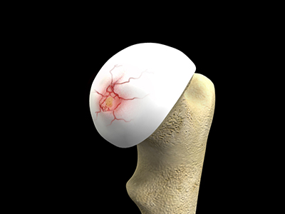 Recovery Cartilage defects
