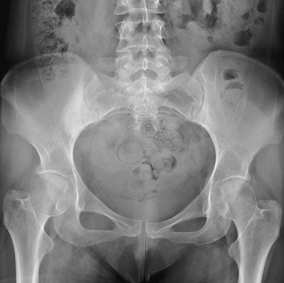 Hip Labral Tear