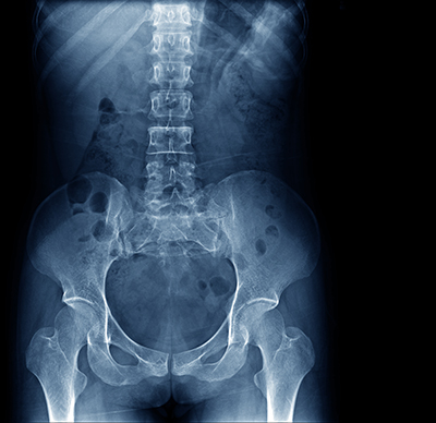 Hip Replacement