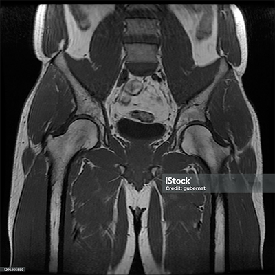 Recovery gluteus medius tear