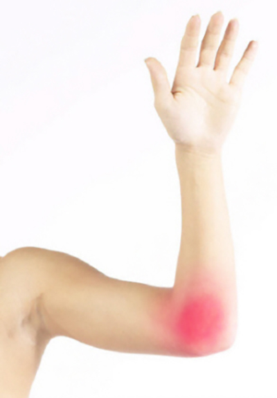 Elbow Sprain