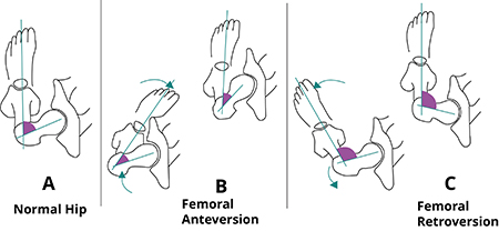 Hip Alignment Abnormalities - 1 - Educational Photo
