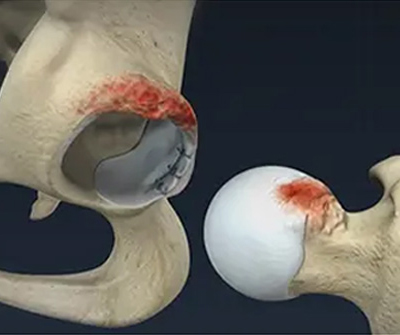 Diagnosis Femoroacetabular Impingement