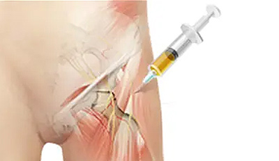 Treatment Femoroacetabular Impingement