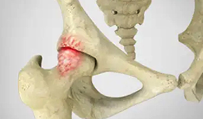 Symptoms Femoroacetabular Impingement