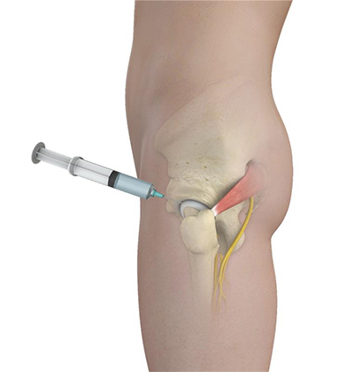 Recovery gluteus medius tear