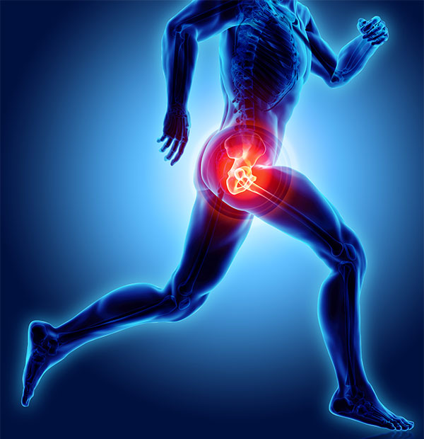 Greater Trochanter Pain Syndrome