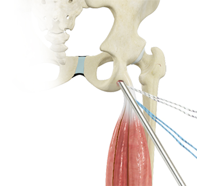 Proximal Hamstring Tear