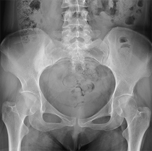 Hip Alignment Abnormalities - 5 - Educational Photo