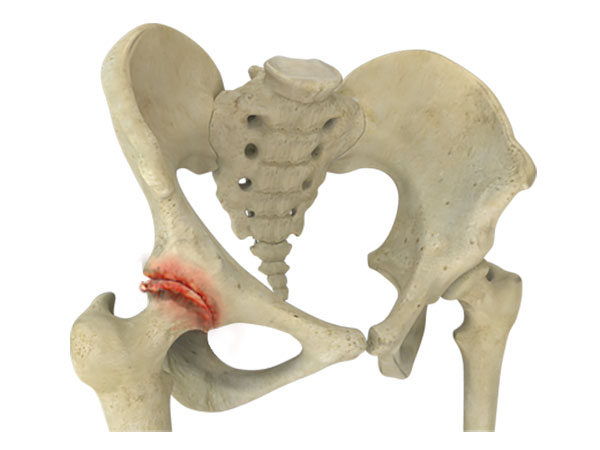 Hip Arthritis