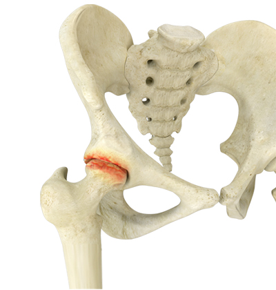 Hip Replacement