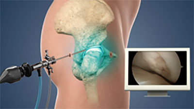 Subspine Impingement