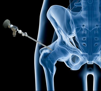 Ischiofemoral Impingement