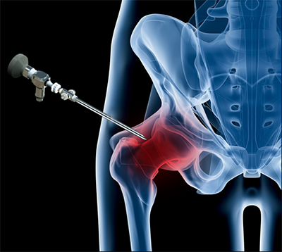 Reasons for Hip Arthroscopy
