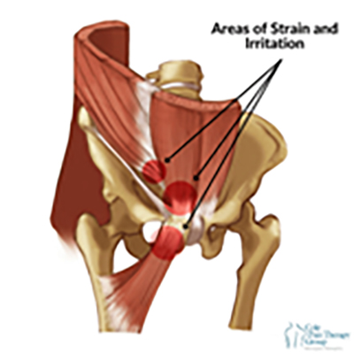Athletic Pubalgia