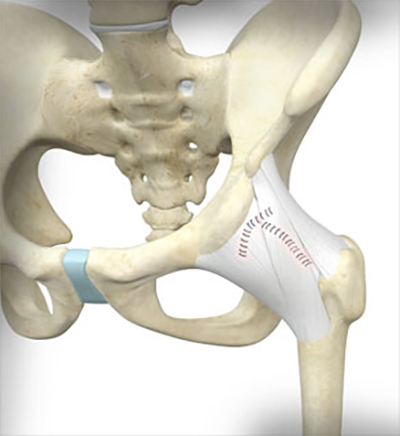 Ehlers Danlos Syndrome