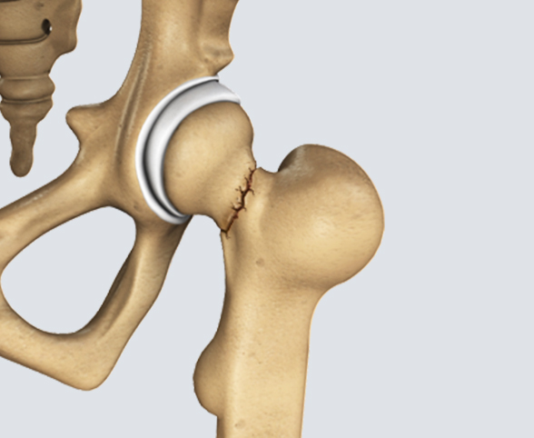 Hip Conditions