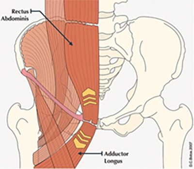 Core Muscle Injury