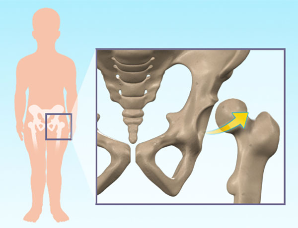 Hip Arthritis