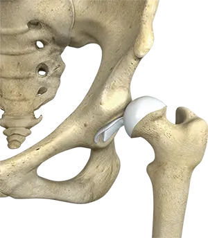 Hip Instability