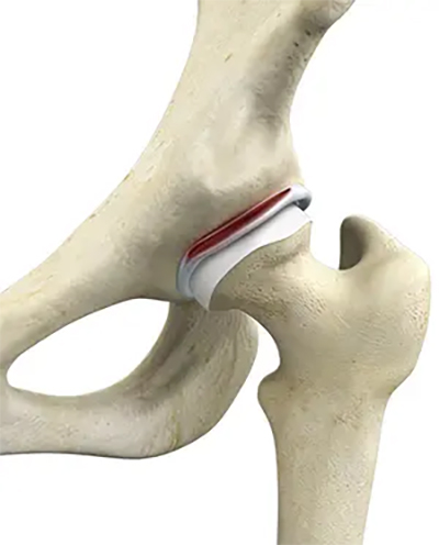 Hip Labral Tear