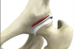 American Hip Institute cited in Orthopedicstoday for innovating labral reconstruction, a treatment for hip labral tears.